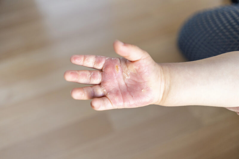 Child's palm with peeling, irritated skin